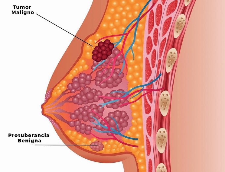 Lo que debo saber sobre C&aacute;ncer de Mama.
