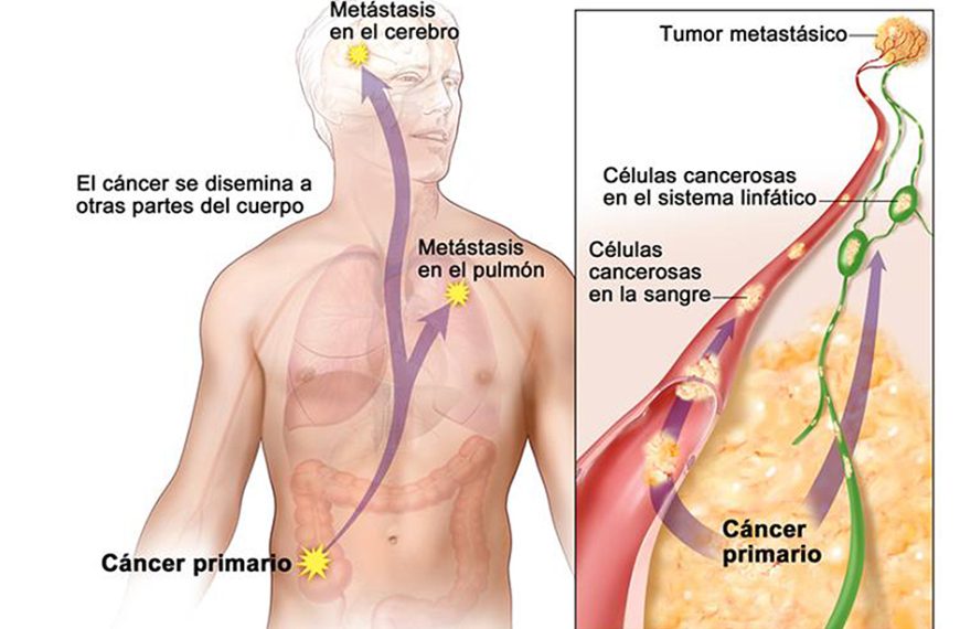 Hablemos del C&aacute;ncer.
